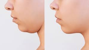 Silicone Double Chin Reducer
