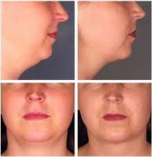 Silicone Double Chin Reducer